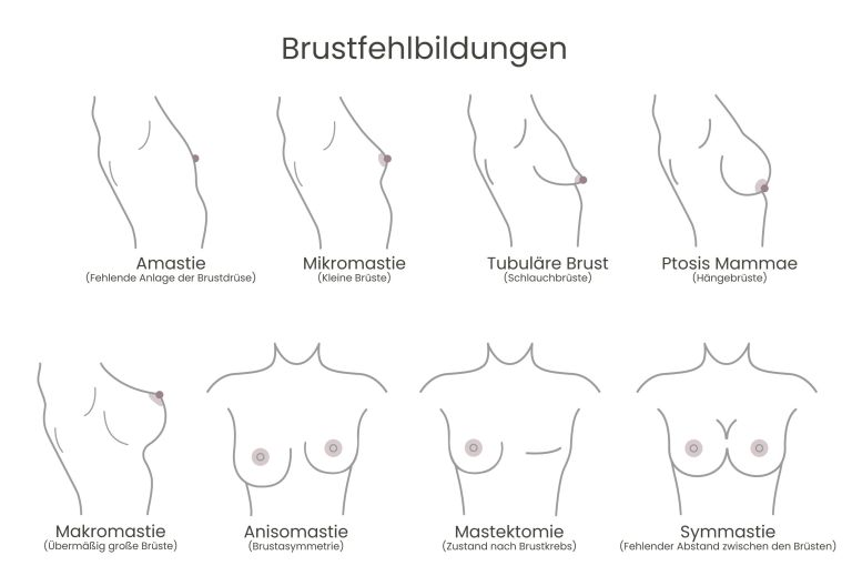 Brustfehlbildungen Berlin - hier sehen sie die verschiedenen Arten der Brustfehlbidlungen