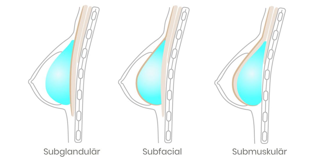 Brustvergrößerung mit Implantate Berlin - die verschiedenen Positionierungen der Implantate