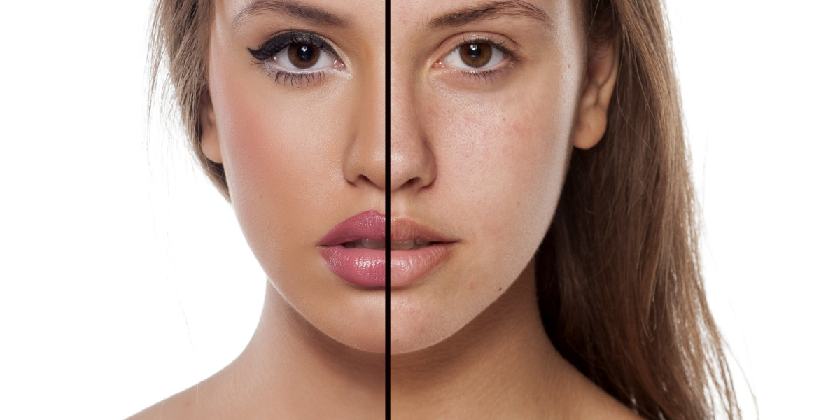 Vorher/Nachher Bild einer Lippenvergrößerung