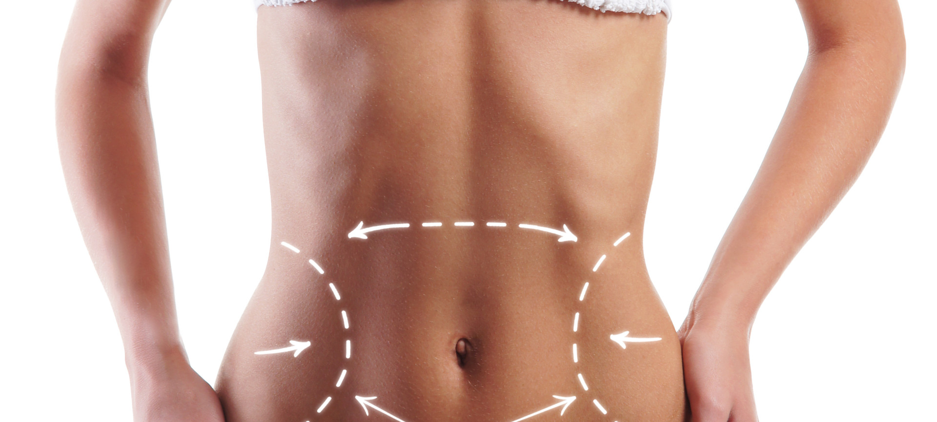 Patientin nach einer Fettabsaugung am Bauch